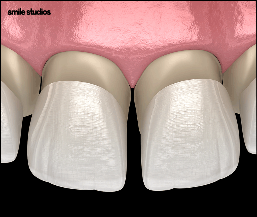 라미네이트 교정 효과를 기대할 수 있는 케이스는? 관련 이미지 8