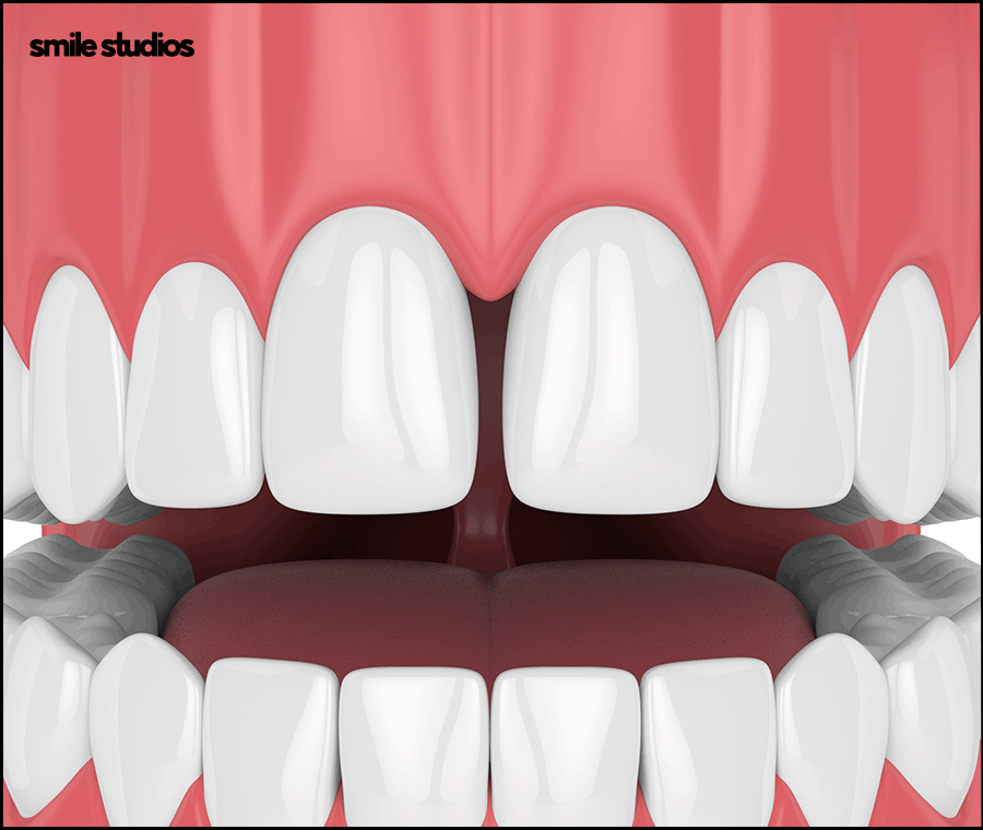 Why Are Veneers Preferred for Gaps Between the Front Teeth? image 7