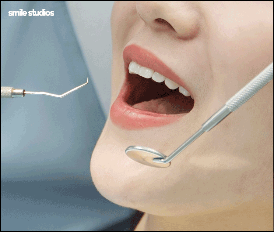 앞니 블랙트라이앵글 보완을 위한 라미네이트 효과 관련 이미지 6