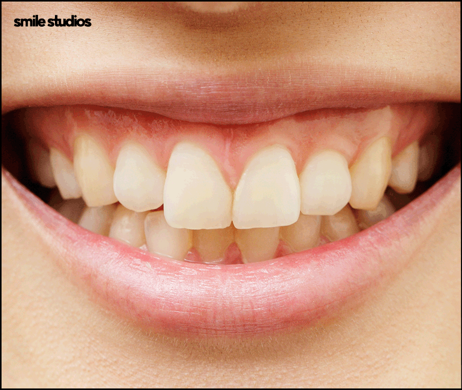 강남역 치과 라미네이트 섬세한 접근의 중요성 관련 이미지 4