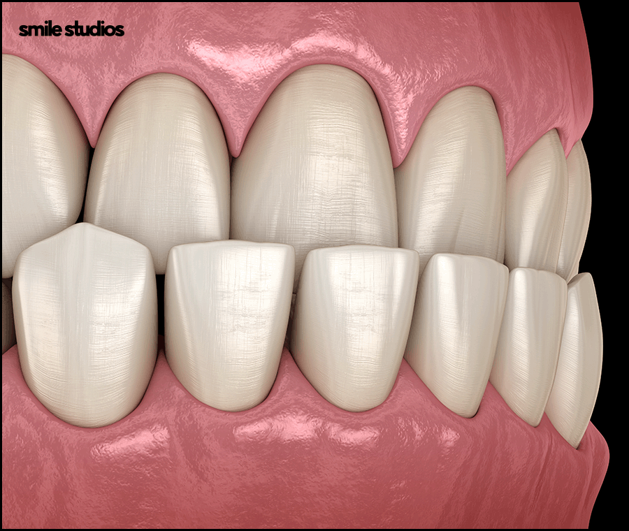 선정릉역치과 인비절라인 교정 전 필수 확인 사항 관련 이미지 6