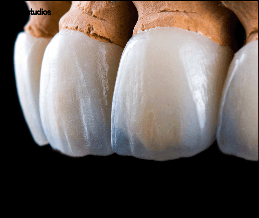 신사동치과 라미네이트 수명 늘리는 방법 A to Z 관련 이미지 9