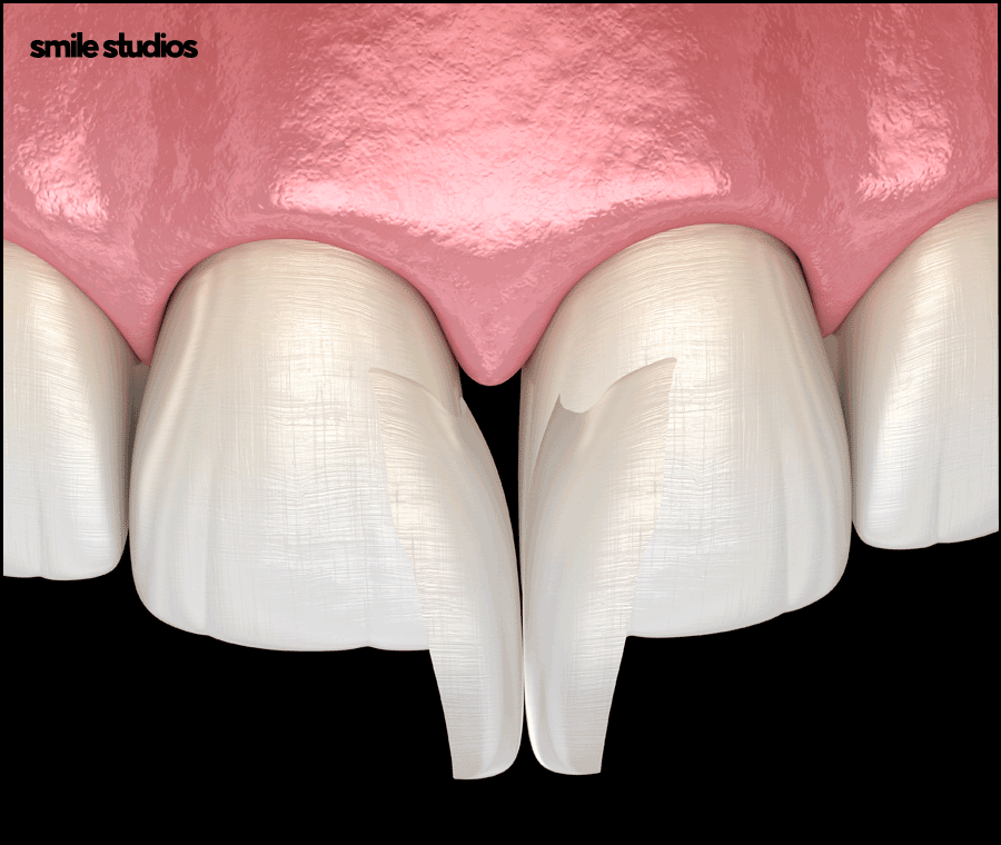 논현역 치과 라미네이트 시술 전 필수 확인 사항 관련 이미지 2