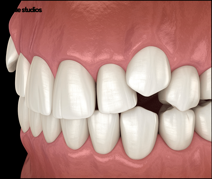 덧니라미네이트 해결 가능할까요? ft. 가능한 케이스 관련 이미지 6