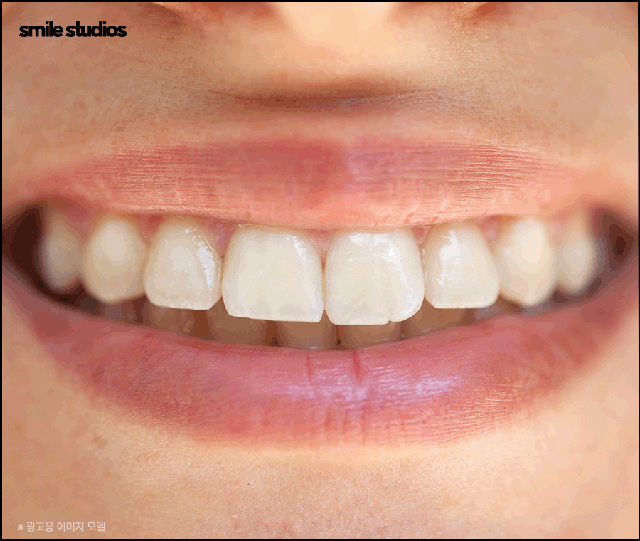 돌출입 인비절라인 기간, 과정, 개선 효과 관련 이미지 6