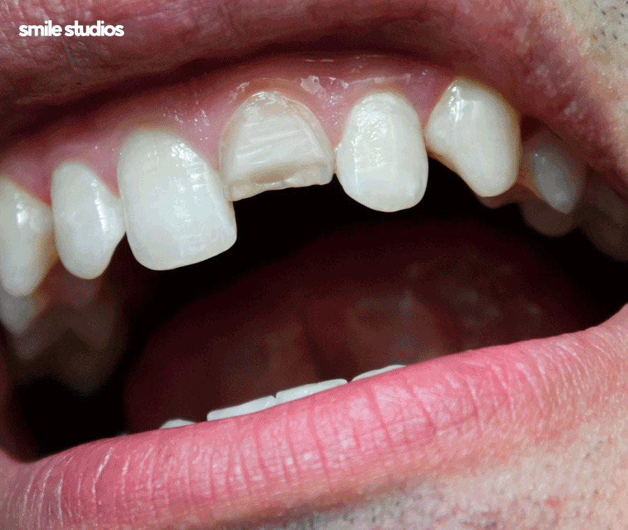 이빨깨짐 치료 치기를 놓치면 위험한 이유는? 관련 이미지 3