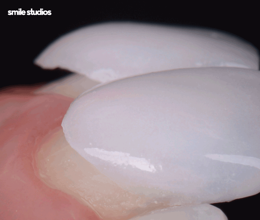 서초 신논현 치과 무삭제 라미네이트 특징, 장단점 관련 이미지 8