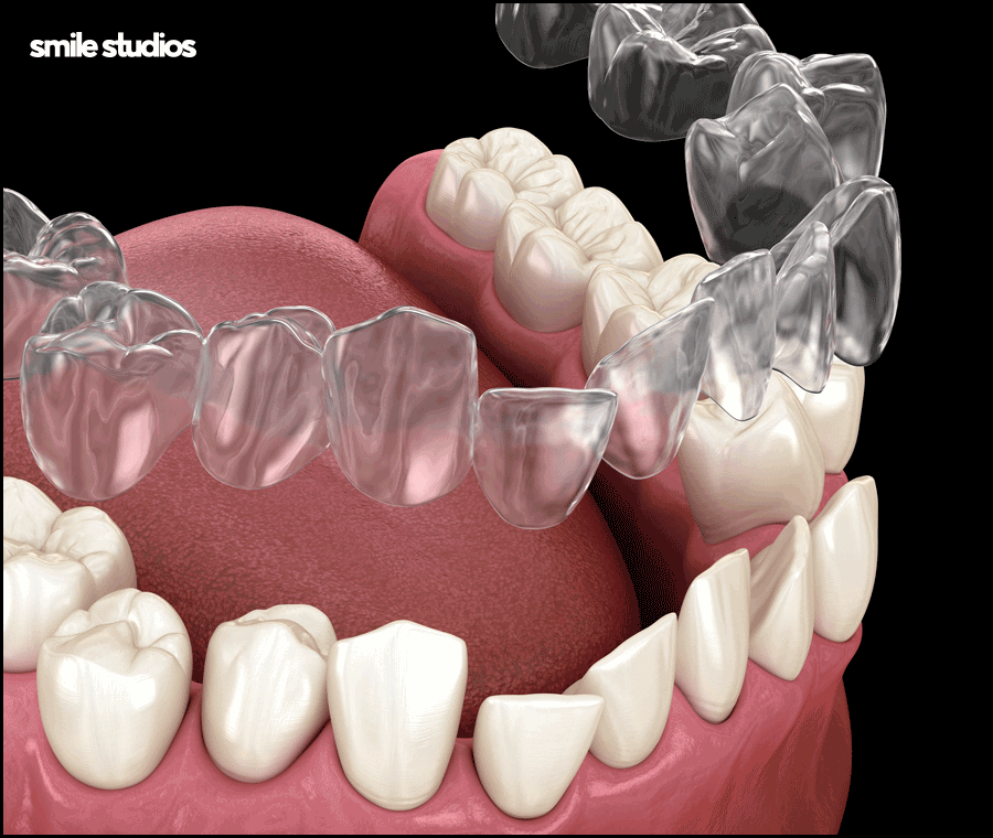 인비절라인 통증이 적은 결정적인 이유 알아보기 관련 이미지 5