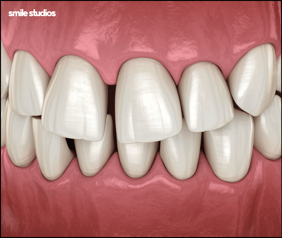 과개교합 교정을 위한 나노라이너 특징 총 정리 관련 이미지 2