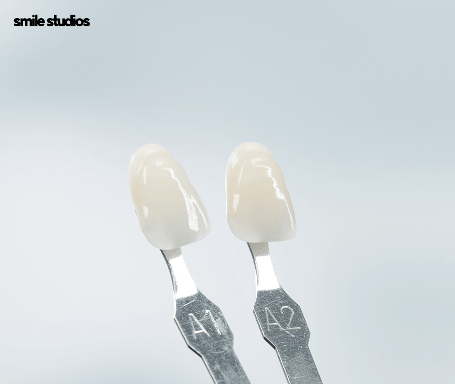 논현 라미네이트 시술 고민된다면 필수체크 관련 이미지 7