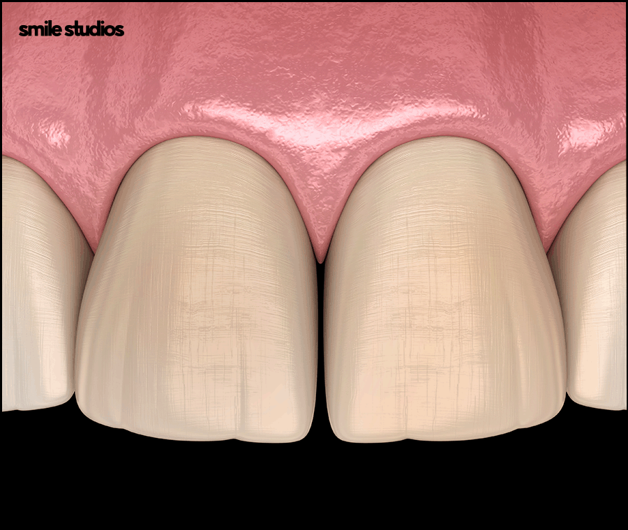 앞니 라미네이트가격 확인 시 같이 체크할 OO은? 관련 이미지 5