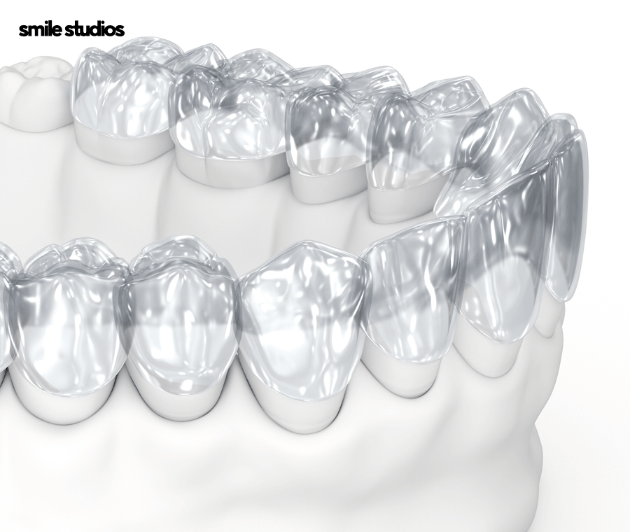 언주역 치과 치아교정 하려면 체크할 3가지 관련 이미지 6