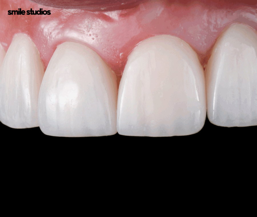 앞니깨짐 치료, 라미네이트 수복 여부, 효과 관련 이미지 10