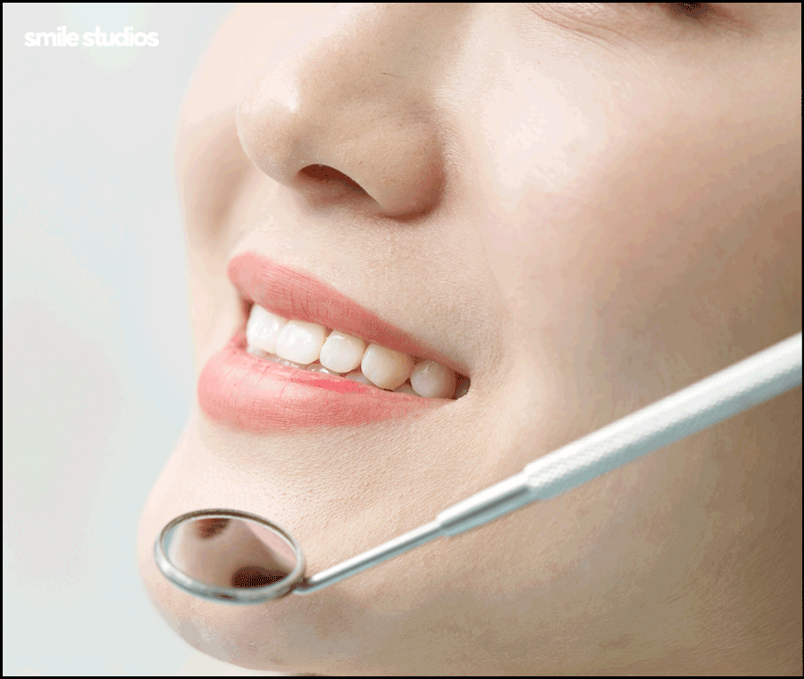 거미스마일 미소의 결함, 해결 방법 ft. 라미네이트 관련 이미지 4