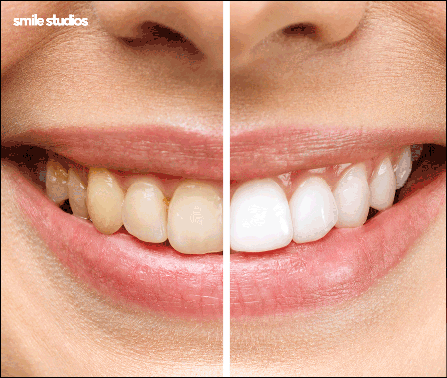 역삼역 치과, 치아 파임 증상 라미네이트 효과는? 관련 이미지 6