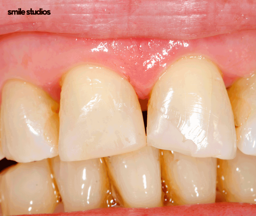 치아 사이 검은색 나타나는 이유, 회복 방법은? 관련 이미지 6