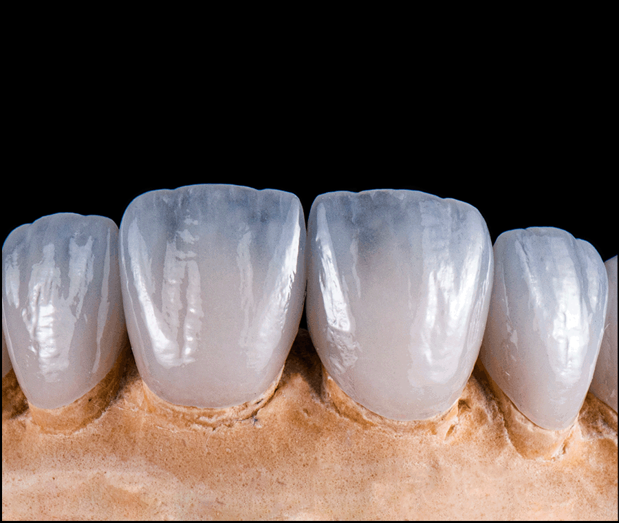 최소삭제 라미네이트 성공하려면 체크할 점 관련 이미지 9