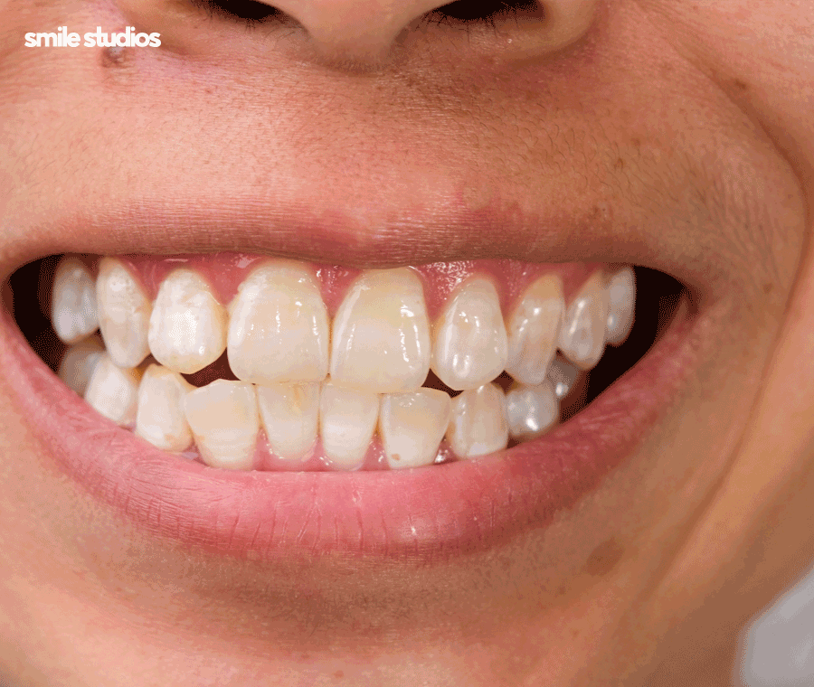 압구정 교정치과 인비절라인, 나노라이너 선택 기준 관련 이미지 7