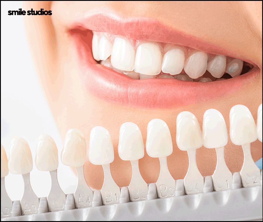 치아반점치 흰얼룩 발생하는 원인, 회복 방법 관련 이미지 6