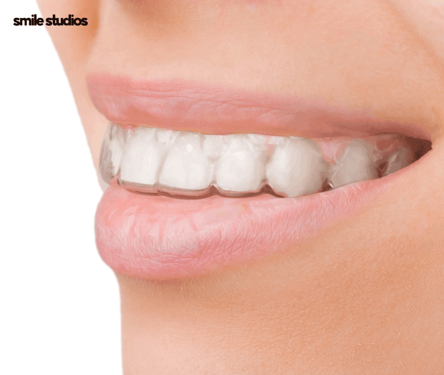 연예인 치아교정 심미성이 우수한 방법 2가지 관련 이미지 4