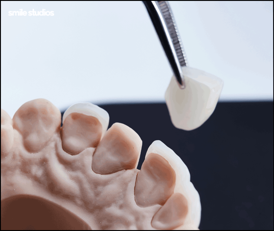 신사동치과 라미네이트 수명 늘리는 방법 A to Z 관련 이미지 3