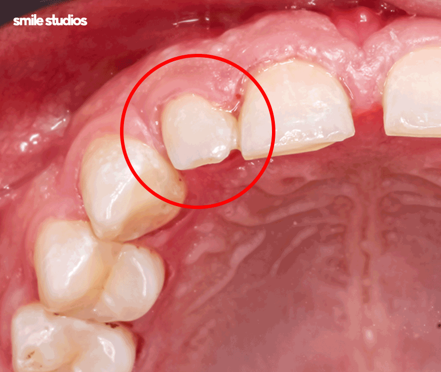 논현 라미네이트 시술 고민된다면 필수체크 관련 이미지 3