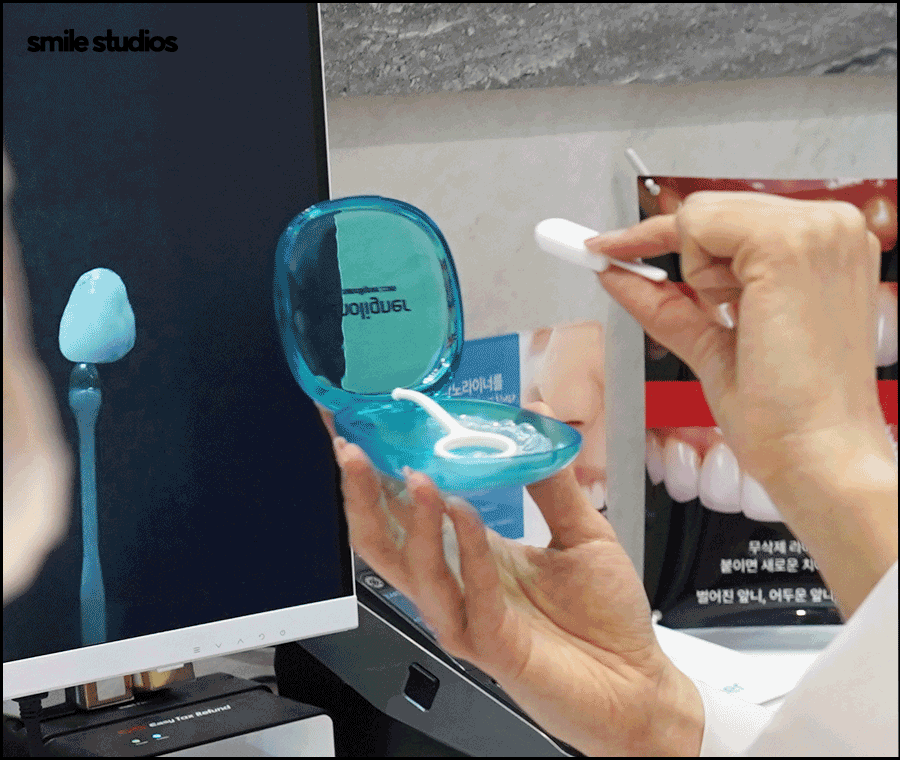 강남 신사역 치과 앞니 벌어짐 교정vs라미네이트 관련 이미지 6