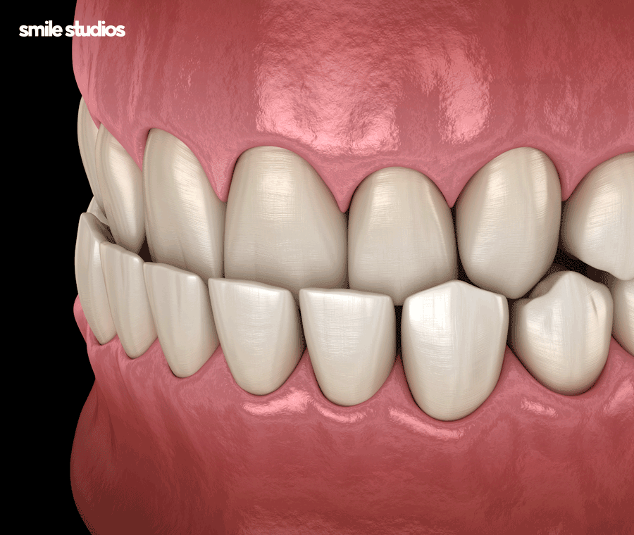 인비절라인 어태치먼트 부착 원리, 탈락 시 대처법 관련 이미지 5
