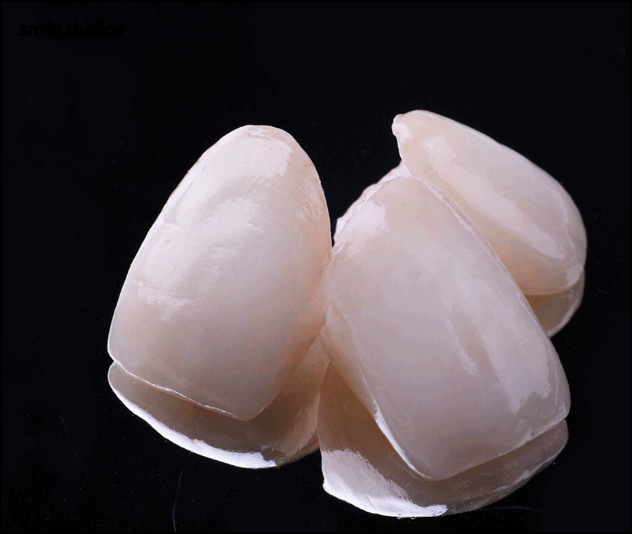 덧니라미네이트 해결 가능할까요? ft. 가능한 케이스 관련 이미지 3