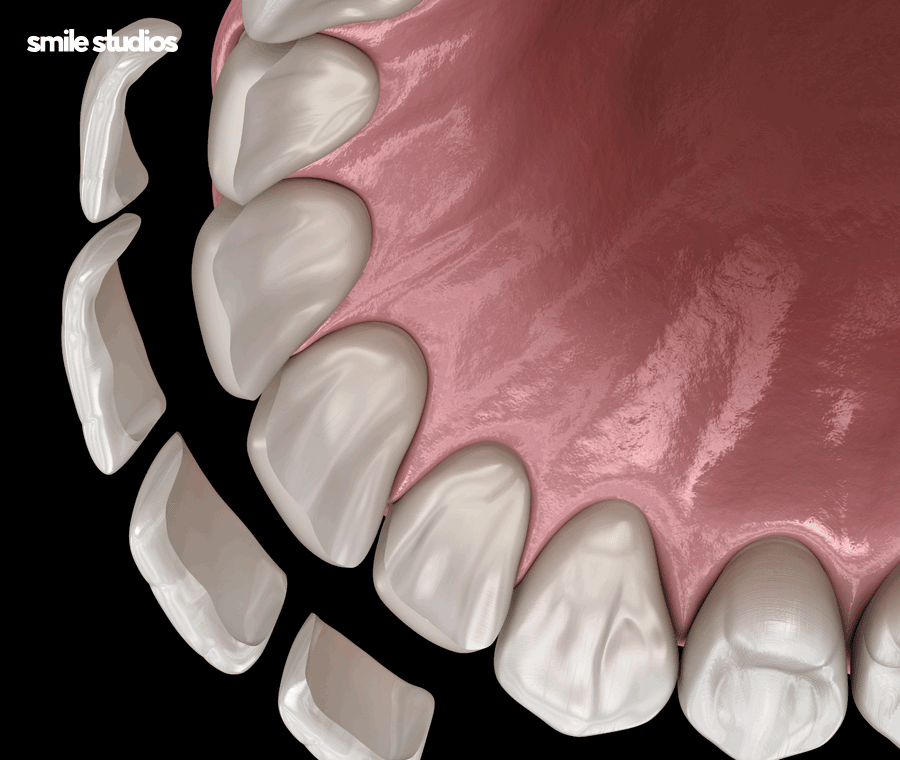 학동역치과 라미네이트 고민된다면 사전에 확인할 점 관련 이미지 3