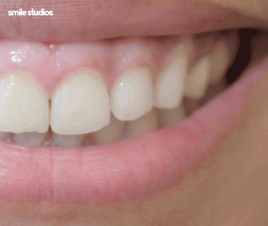 거미스마일 앞니 잇몸 과노출, 원인 및 보완 방법 관련 이미지 10