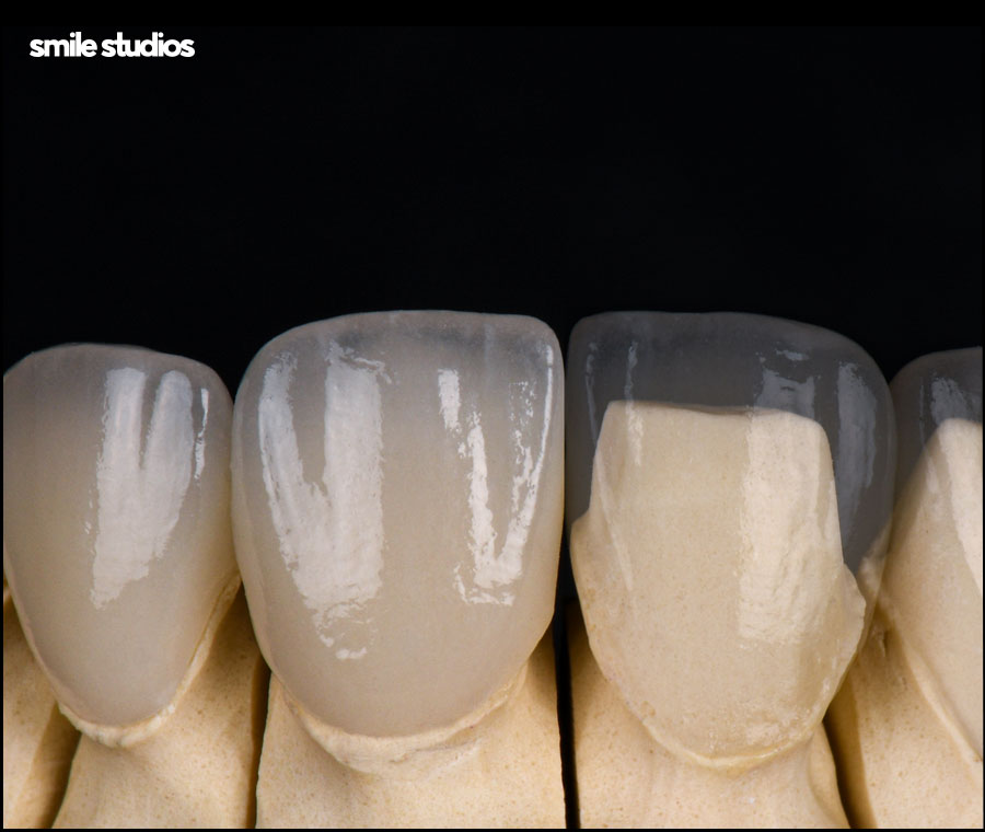 앞니 라미네이트가격 확인 시 같이 체크할 OO은? 관련 이미지 7