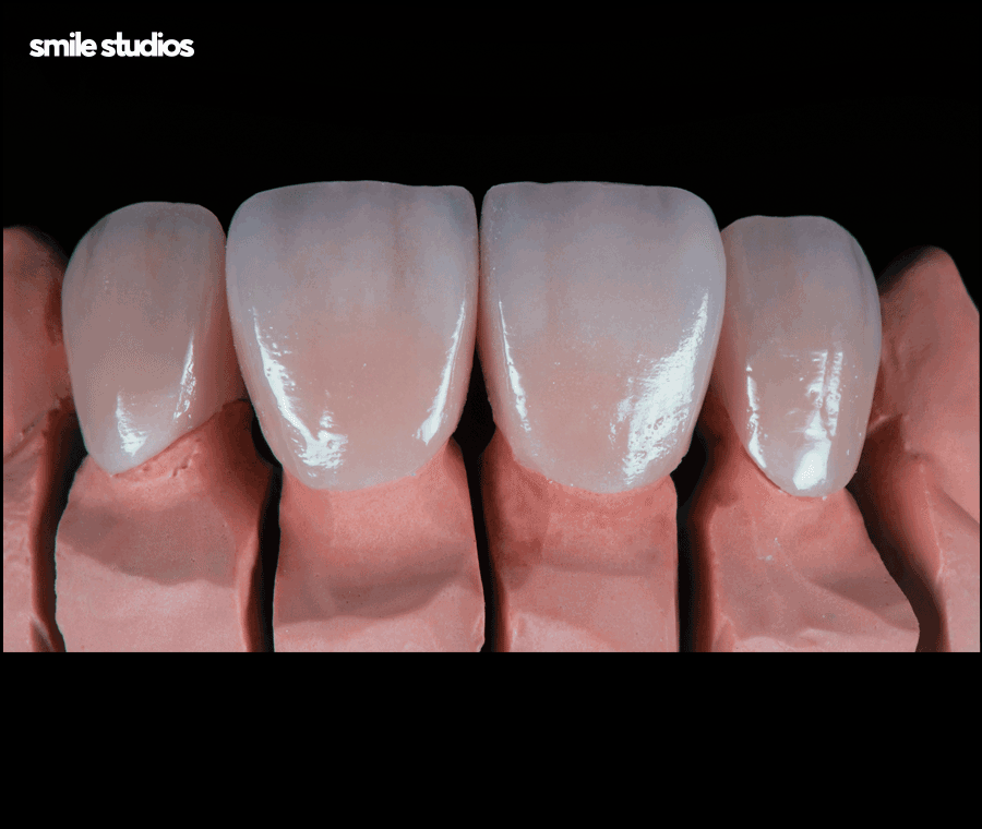 연예인라미네이트 선호도가 높은 이유, 효과 관련 이미지 6