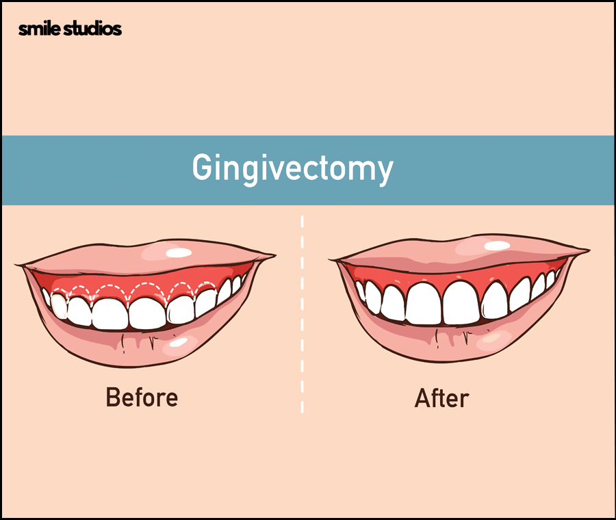 블랙트라이앵글 치료 적합한 방법 알아보기 관련 이미지 5