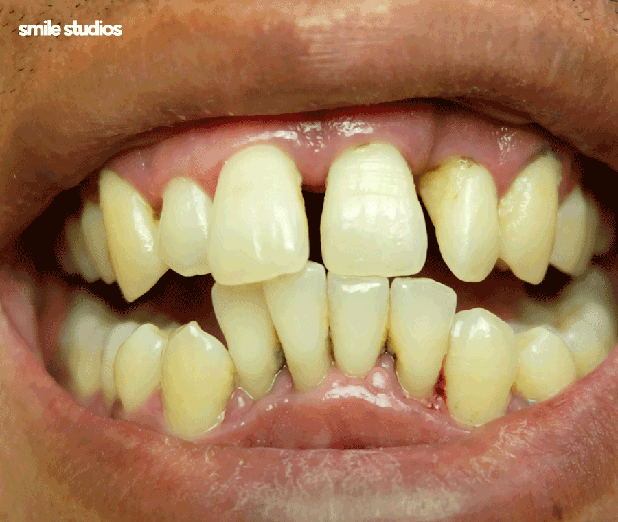 서울 논현동 치과 앞니 투명교정 장단점 총 정리 관련 이미지 3