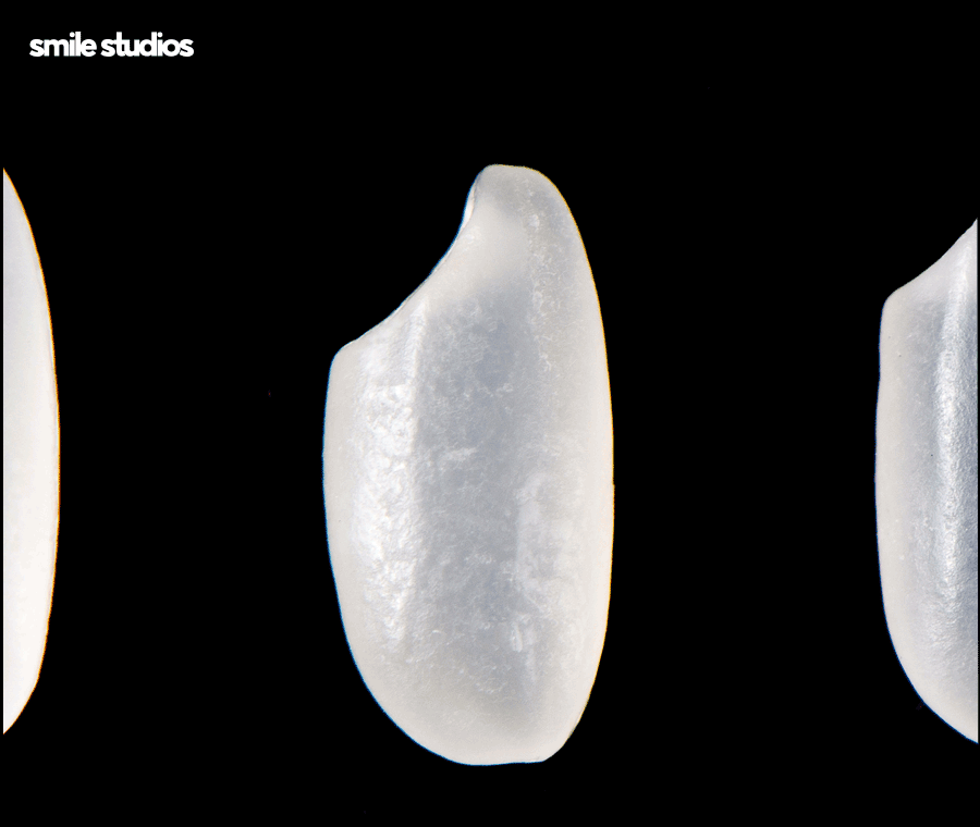 라미네이트 재시술 필요한 케이스, 주의사항 정리 관련 이미지 3