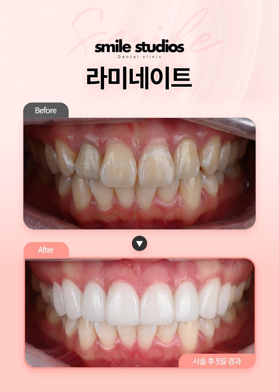 토끼이빨라미네이트, 시간 없다면 더 이상 고민 금지! 관련 이미지 2