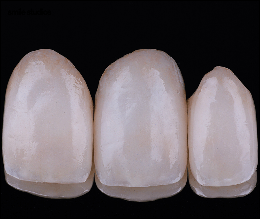 신논현역치과, 라미네이트 시술 전 꼭 확인할 핵심 2가지 관련 이미지 4