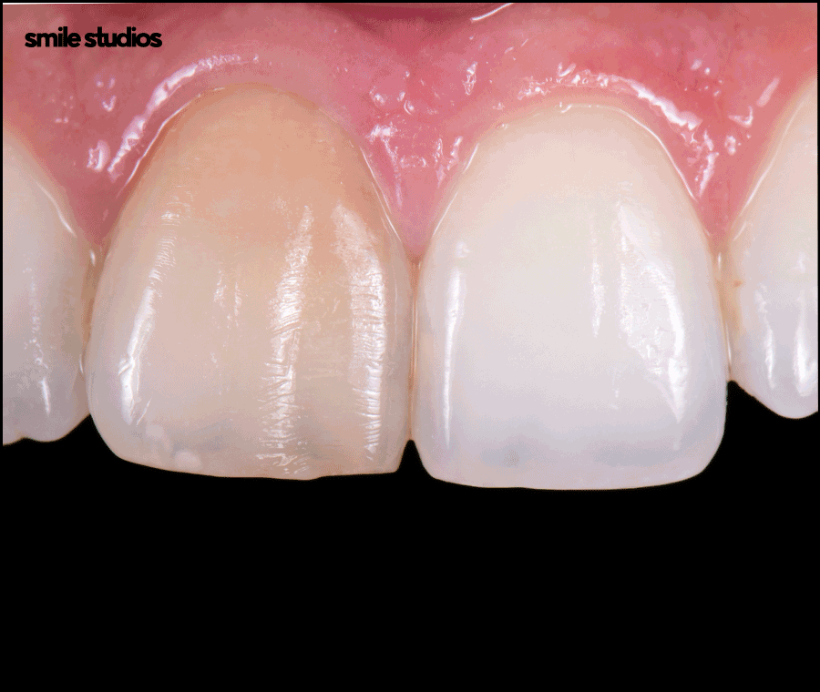 논현역 치과 라미네이트 시술 전 필수 확인 사항 관련 이미지 8