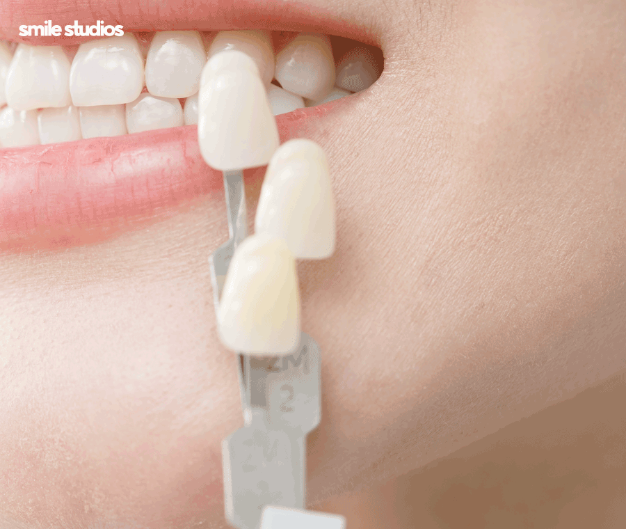 거미스마일 앞니 잇몸 과노출, 원인 및 보완 방법 관련 이미지 8