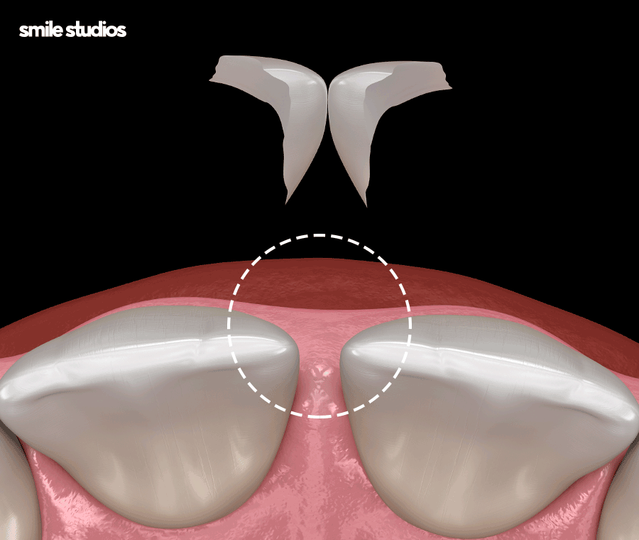 치아사이 벌어짐 가지런한 앞니 만드는 Tip 관련 이미지 6