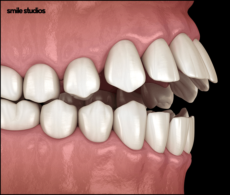 중년치아교정 소요 시간 포함 시작 전 체크할 사항 관련 이미지 2