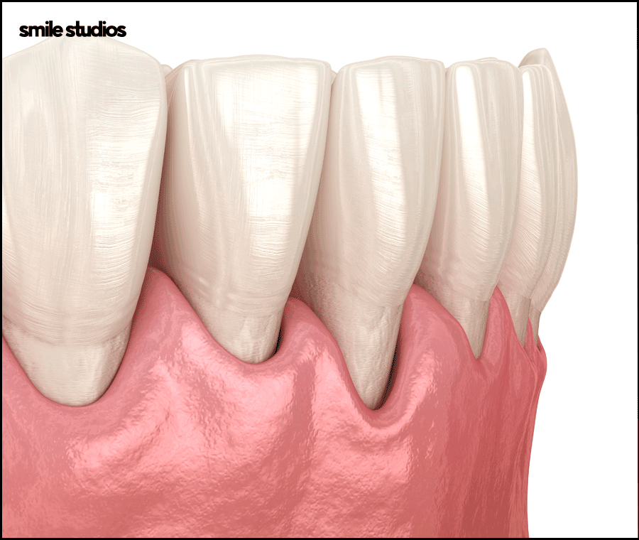 역삼역 치과, 치아 파임 증상 라미네이트 효과는? 관련 이미지 2