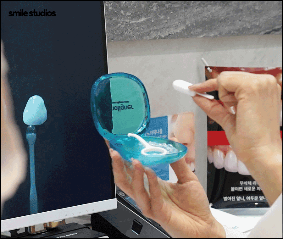 옥니 교정 필요한 이유, 발생 원인, 방법 파헤치기 관련 이미지 9