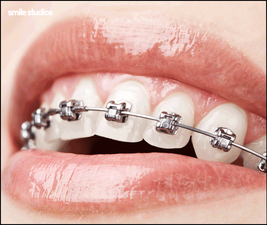 논현동 치과 인비절라인 투명교정 효과, 장/단점 관련 이미지 7