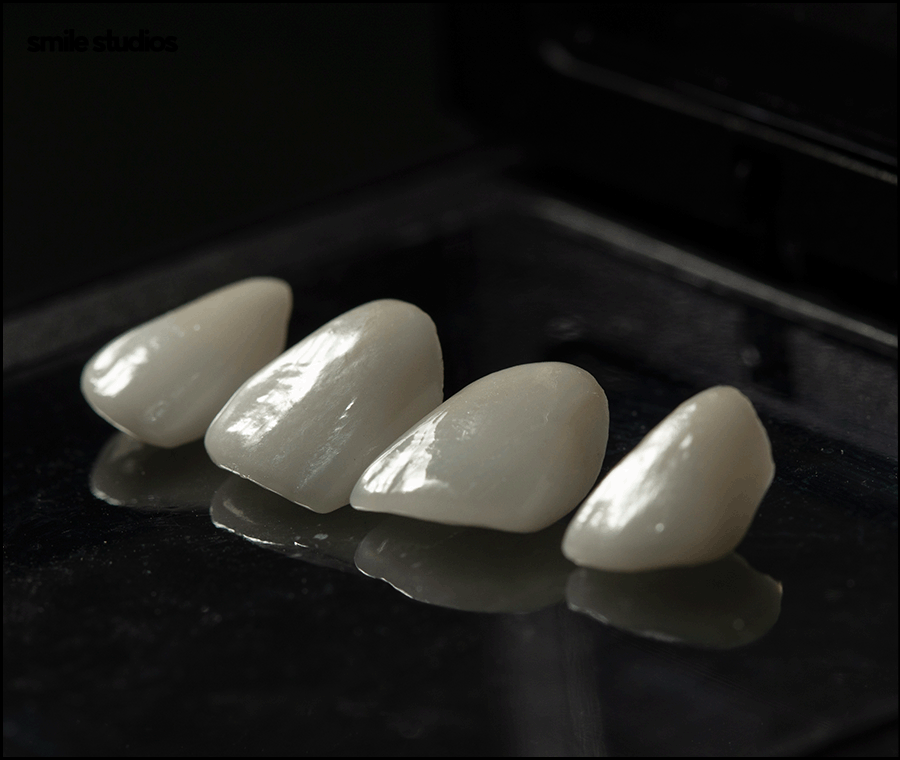 치과라미네이트 고른 치아 만들 때 핵심은? 관련 이미지 7