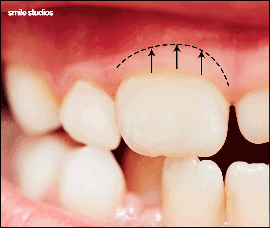 거미스마일 미소의 결함, 해결 방법 ft. 라미네이트 관련 이미지 3