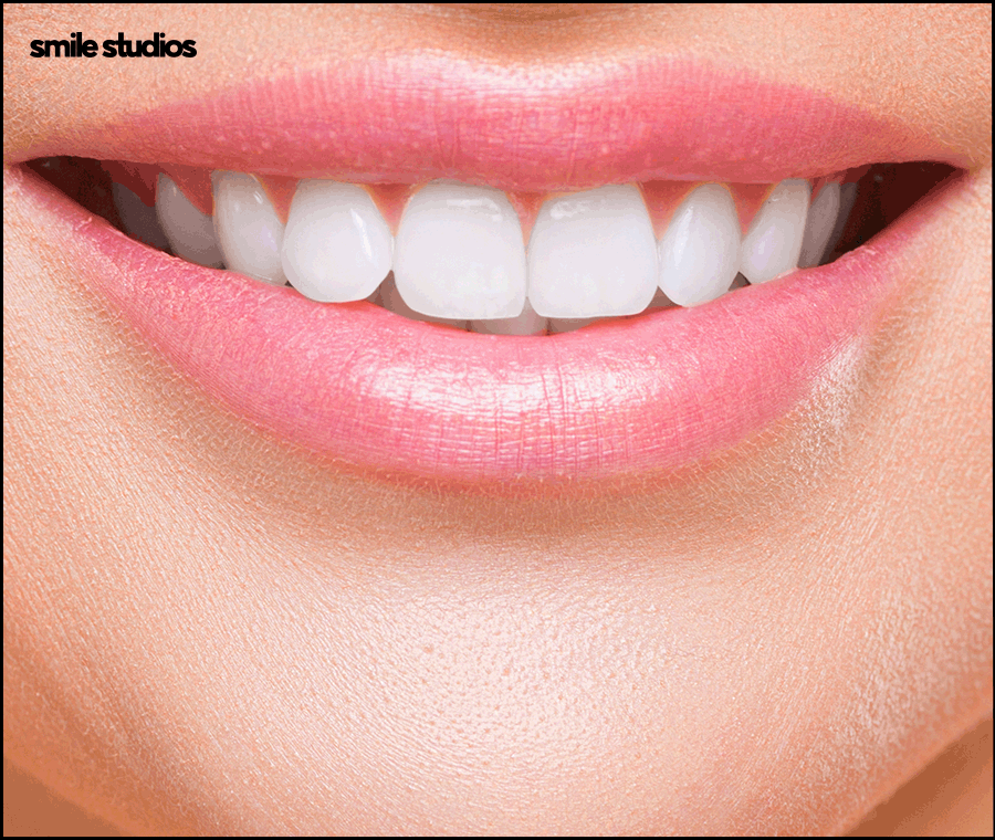 치아반점치 흰얼룩 발생하는 원인, 회복 방법 관련 이미지 9