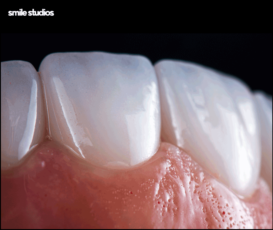 도산대로치과 앞니 라미네이트 크라운 차이점 관련 이미지 4