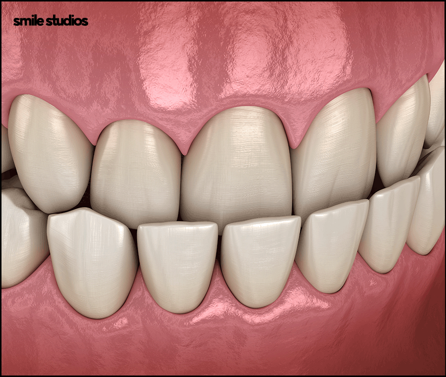 서울인비절라인 권장 케이스, 장점, 치료 시간 정리 관련 이미지 4
